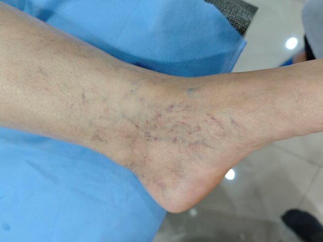 Ankle and Foot Varicose Vein/Spider Vein Treatment